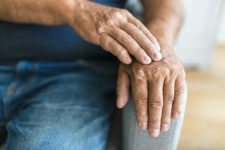Psoriatic Arthritis Treatment: Strategies for Managing a Complex Autoimmune Disease