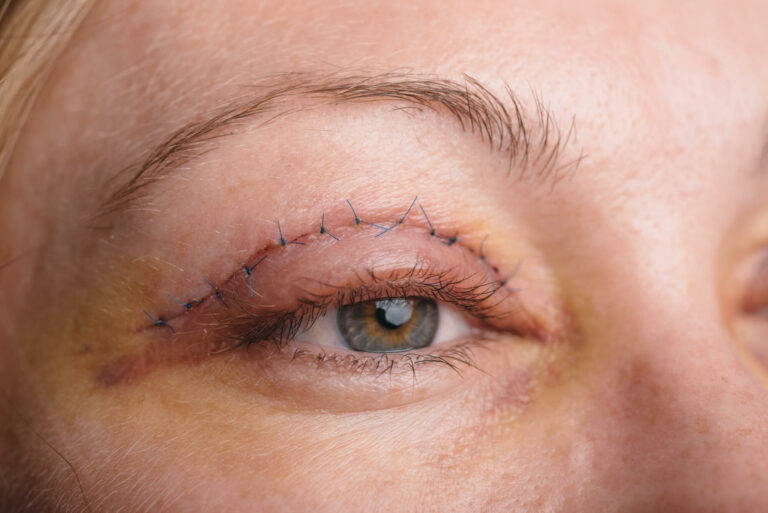 Blepharoplasty Surgery: Enhancing Visual Appearance and Function